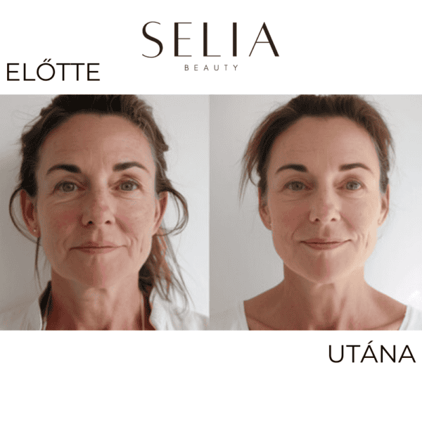 Selia 2.0 - arany mikrotűs kezelés - Image 10