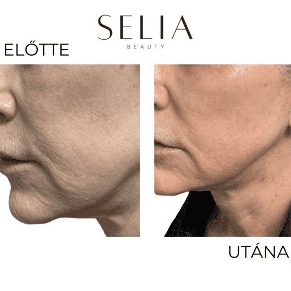 Selia 2.0 - arany mikrotűs kezelés - Image 8