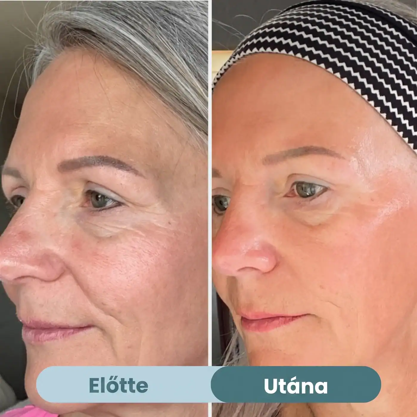 Előtte és utána — Selia Bio-Kollagén Maszk