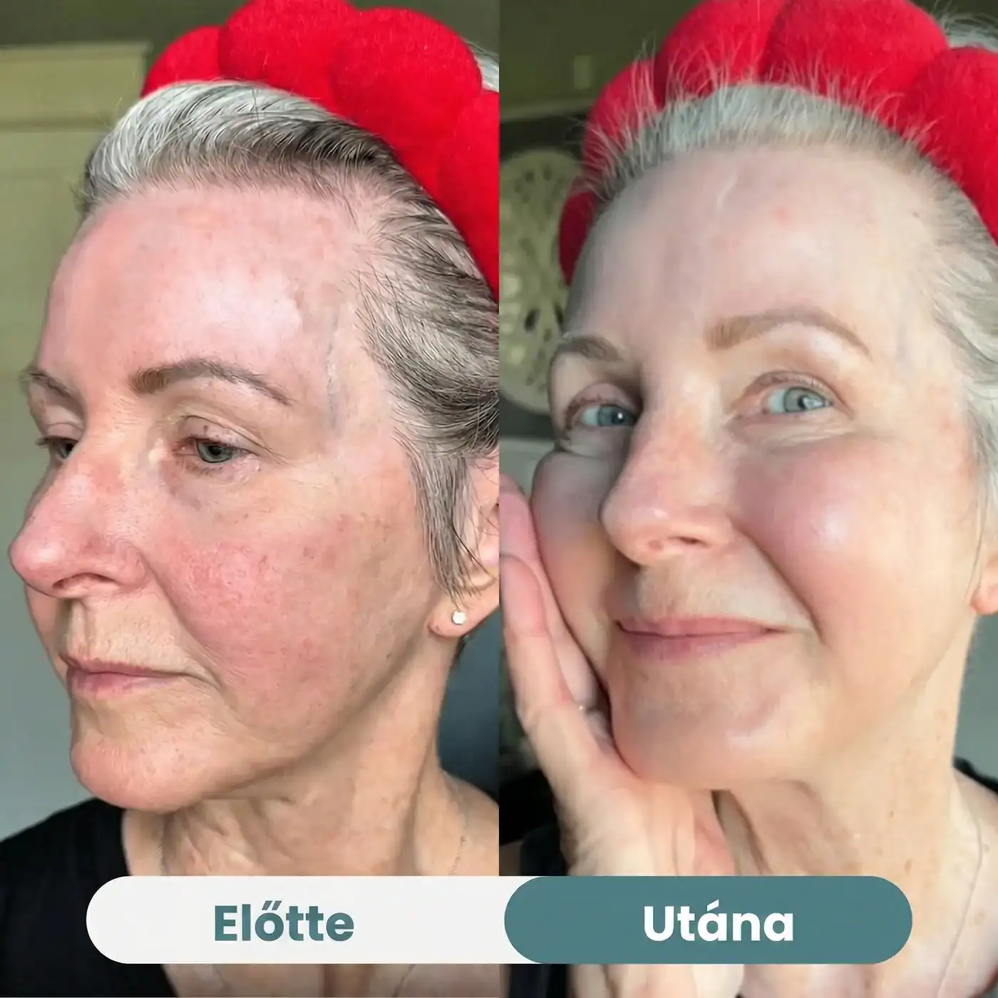 Előtte és utána — Selia Bio-Kollagén Maszk